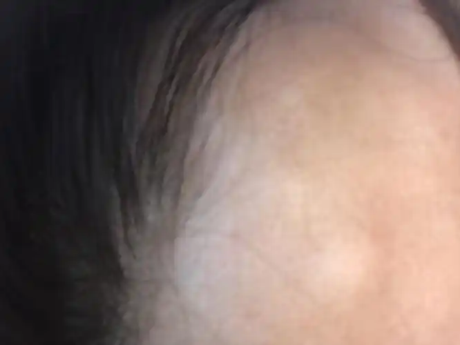 我额头上长了两个小包,已经有十多年了,可最近一个长的大了,有有时