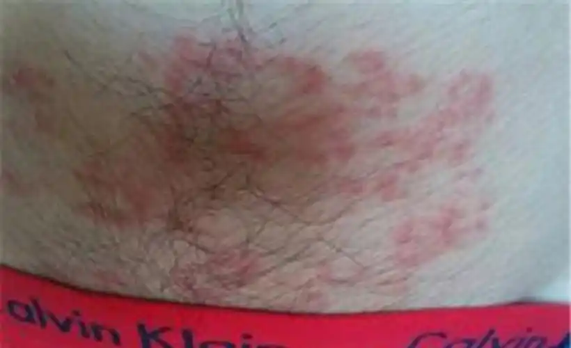 男性症状淋病初期图片 _有来医生