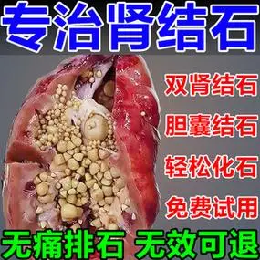 金钱草中草药肾结石排石药化石草特效专用胆尿结石溶石颗粒治疗贴