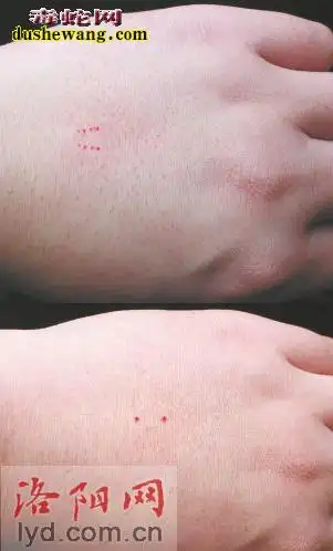 无毒蛇咬伤伤口没有毒蛇那样明显的1个以上的毒牙的牙痕,只是有两排