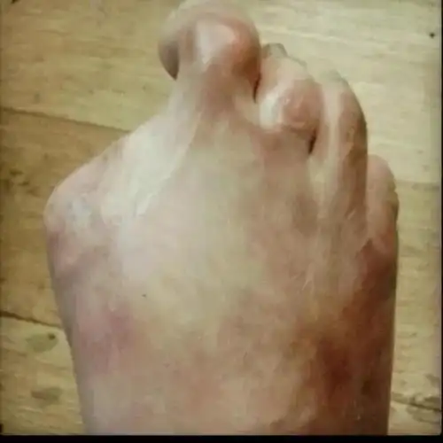 澳洲妹子惨遭截肢生不如死只因做了中国人超爱的这项按摩