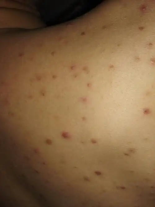 天气变冷为什么长痘痘(为什么天气越冷越容易长痘)