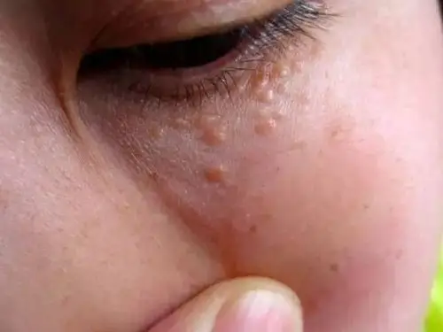 关于各种脂肪粒的合集