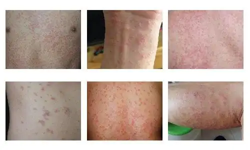 玫瑰糠疹 治疗与预防 - 好大夫在线