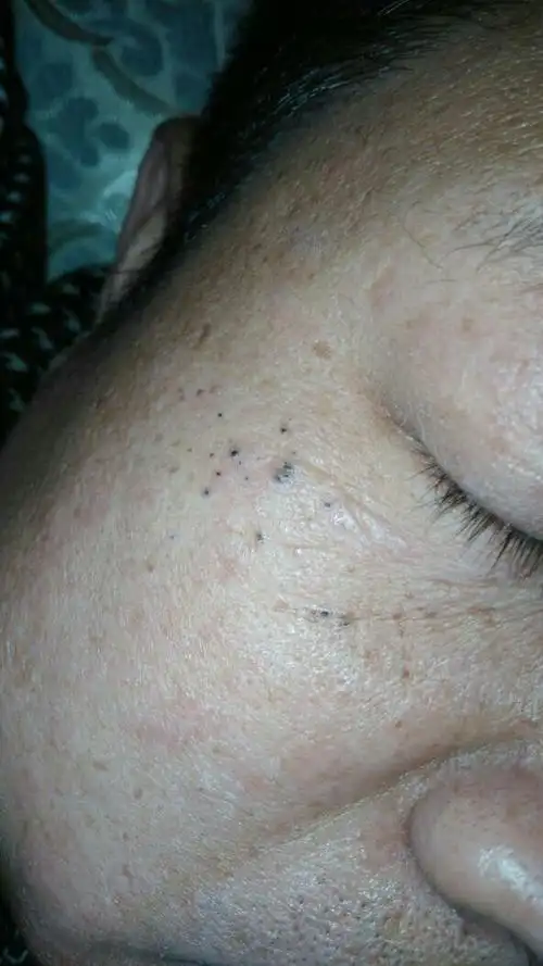 脸上的黑点是什么.对身体有危害吗.