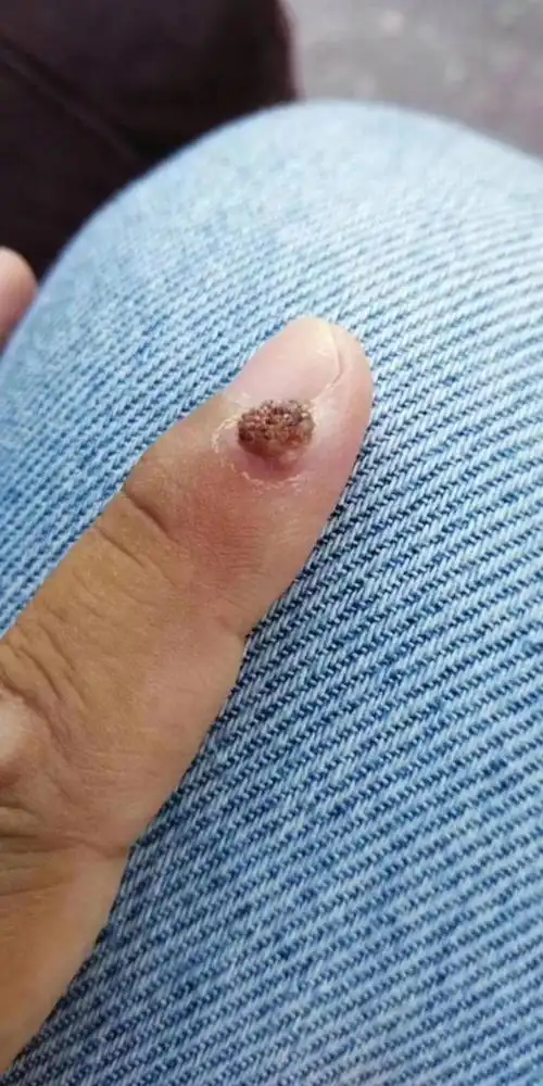 多年的瘊子掉了