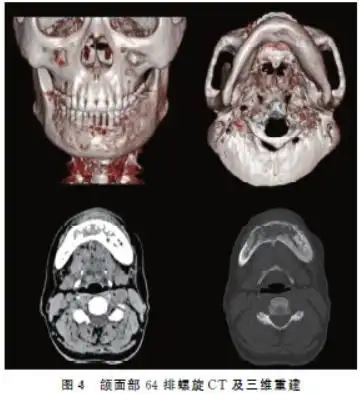 颌骨牙源性硬化性癌的影像学特征分析