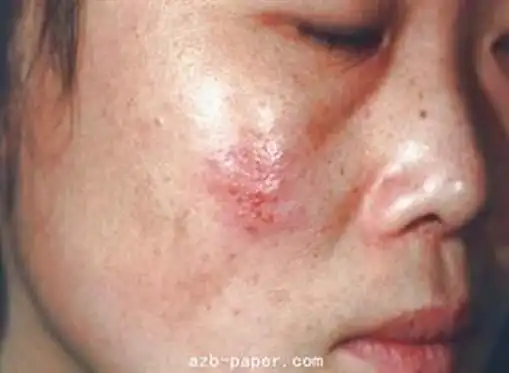 女性生殖性疱疹的症状具有什么特征呢