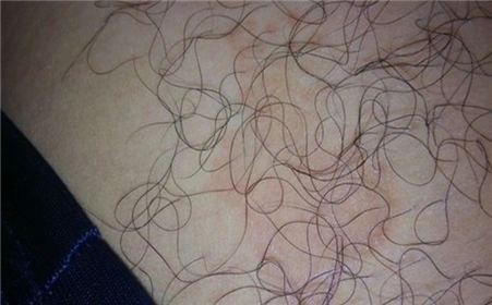 患了阴虱病应注意什么呢