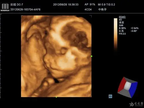 胎儿rubing综合征双侧唇裂