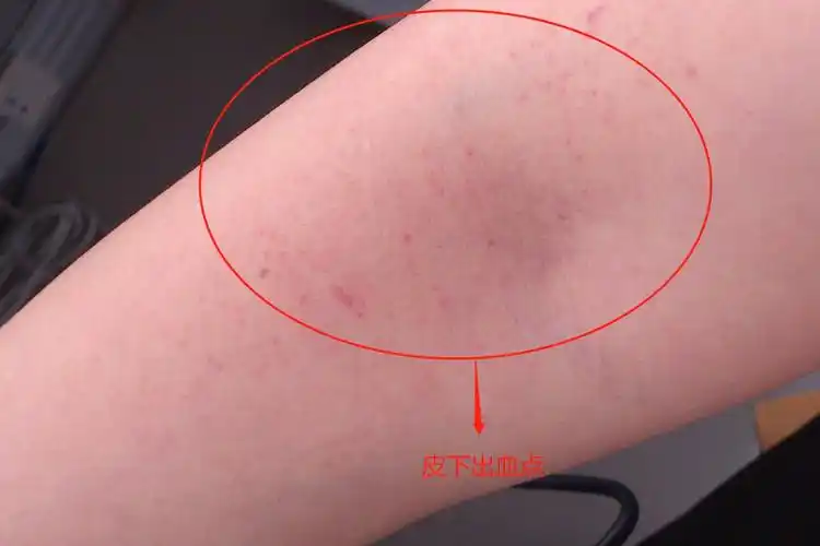 皮下出血点皮下出血点是指人体内毛细血管破裂造成