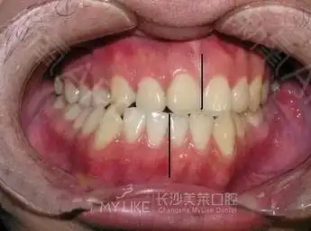 牙齿中线不齐,矫正治疗过程全程模拟,魔力橡皮筋,一起看看