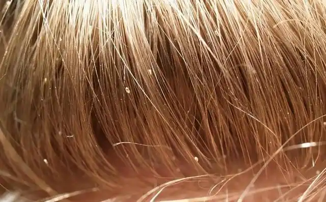 阴虱|头虱|虱子|体虱_网易订阅