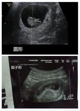 可是通过孕囊形状,真的能看出男女吗?来看看网友的说法.