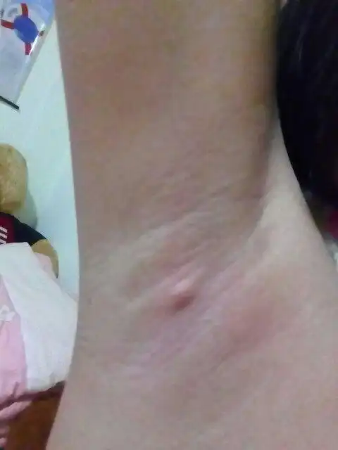 我的咯吱窝下面长了一个小疙瘩,一碰就疼,一挤,还流脓了,是怎么回事?