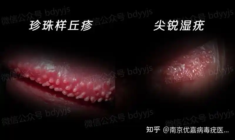 那么,对于珍珠样丘疹与尖