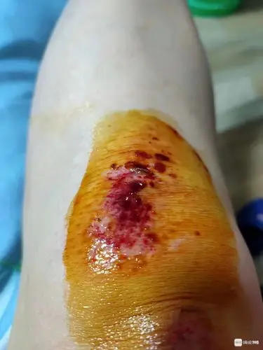 经编园被车撞伤,腿上破皮流鲜血!肇事者飞快逃离现场