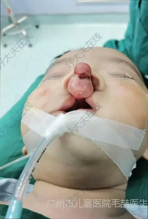 患者为严重的双侧完全性唇腭裂,前颌骨前突明显,唇部软组织不足,鼻翼