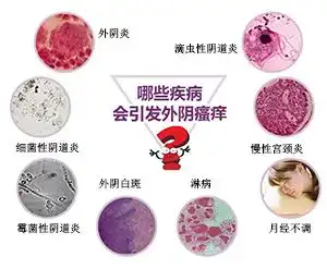 妇科 妇科炎症 外阴瘙痒 导读 外阴瘙痒是妇科疾病中很常见的一种