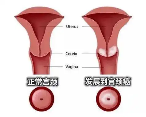是可覆盖hpv16/18两种病毒亚型的疫苗,能够预防宫颈癌,外阴癌,口咽癌