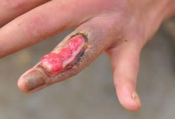 朋友被眼镜蛇咬了(提醒:图片可能引起不适)