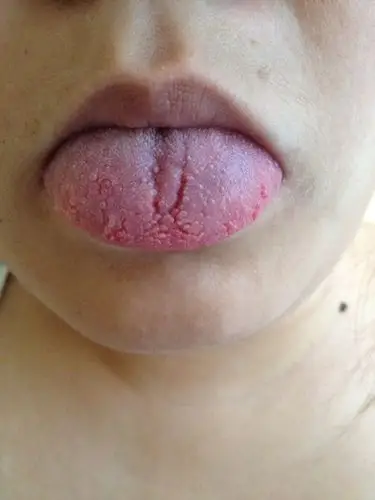 求助…我这舌头是不是不正常呃…怎么回事呃…以前没有裂纹…也比现在