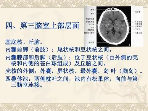 所有分类 医药卫生 临床医学 头部ct基础及断面解剖ppt 四,第三脑室