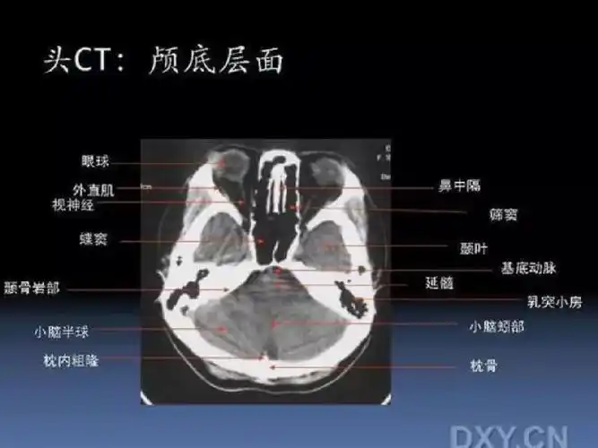 正常头颅ct与mri断层解剖ppt