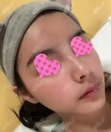 鼻综合术后15天时候的恢复照片