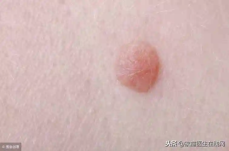 扁平疣的最佳治疗方法怎样治扁平疣最好方法