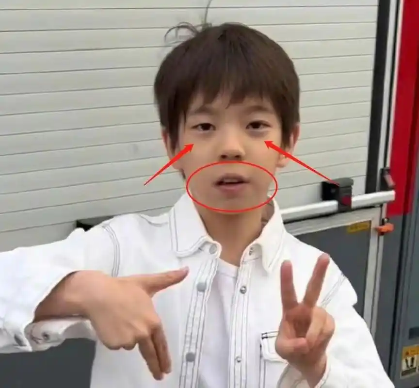 龅牙嘴凸疑腺样体面容,网友劝其抓紧就医  前段时间,陆毅鲍蕾夫妇参加