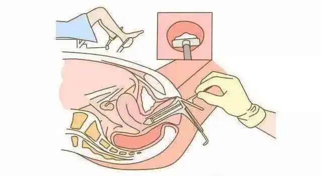 关于阴道镜检查你需要知道的几件事