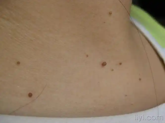 看看这些赘生物是什么如何治疗