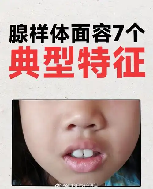 腺样体面容166眼裂变小266眼距增宽366鼻翼外掀466鼻唇沟变
