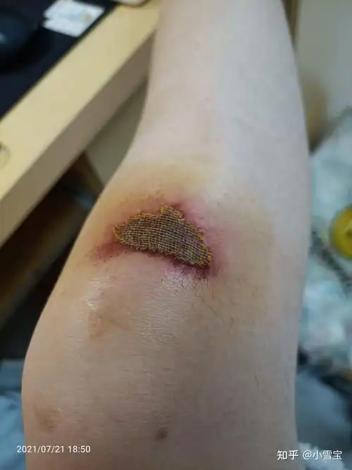 膝盖擦伤到好的整个过程