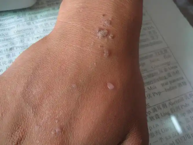 扁平疣 - 皮肤及性传播疾病讨论版 - 爱爱医医学论坛