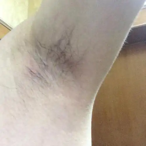 腋下长包了,今天才发现,这是怎么了啊?男,25岁.