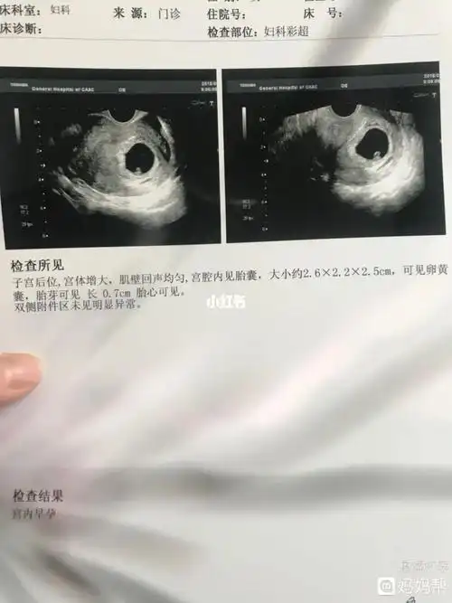 有一种说法认为,在怀孕9周之前通过b超看胎囊的形状可以判断出男女