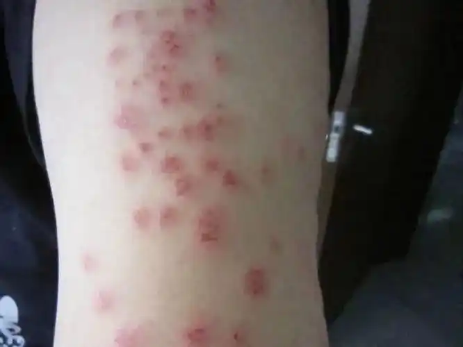 以人类血液为食多国爆发床虱危机已蔓延至亚洲