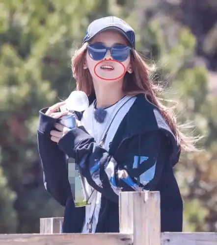 什么叫牙齿拯救一张脸?杨超越戴牙套,脸部变化照传出,被美圈粉