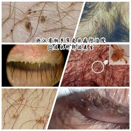 难言之隐:阴虱病