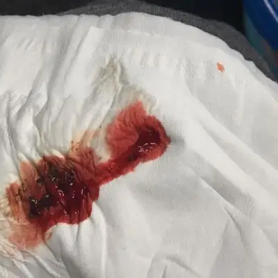 宝妈们……我现在27周6天这两次拉便便都出血了!