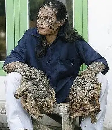 世界十大最恶心皮肤病皮肤蝇蛆病就是莲蓬乳图