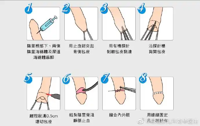 包皮过长达40%～70%,包茎达10%～20%,所以包茎过长对于,对于青少年