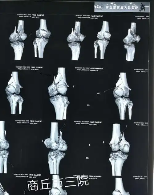 股骨髁间粉碎性骨折(c2型)