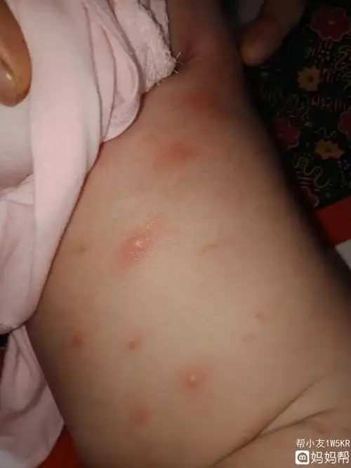 为什么天气一冷就长痘痘(为什么天气一冷就长痘痘怎么回事)