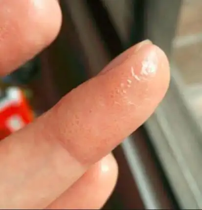 手上起水泡很痒是什么原因手上起水泡怎么回事