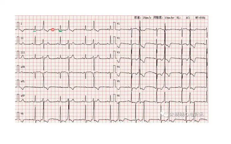 【心电图学习12】| 各种各样的室早:室早二联律,间位室早,室早三联律