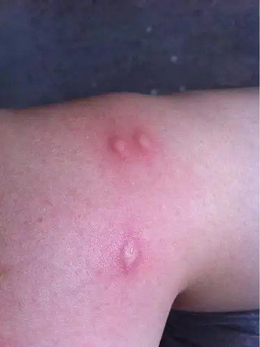 这是被什么虫子咬了啊,非常痒,抓破了有液体,孕妇能用药膏吗