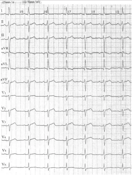 图21-9 左前分支阻滞